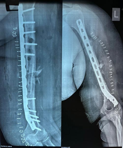 Non union fracture treatment in Vijayawada