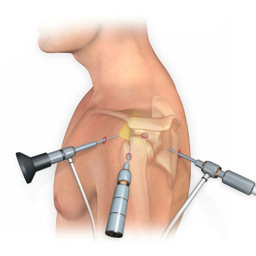 Shoulder Arthroscopy in Guntur